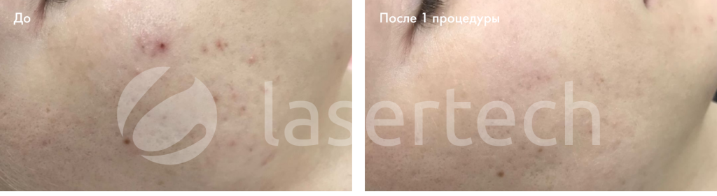 карбоновый-пилинг-до-после-комбайн2.png карбоновый-пилинг-до-после-комбайн2.png