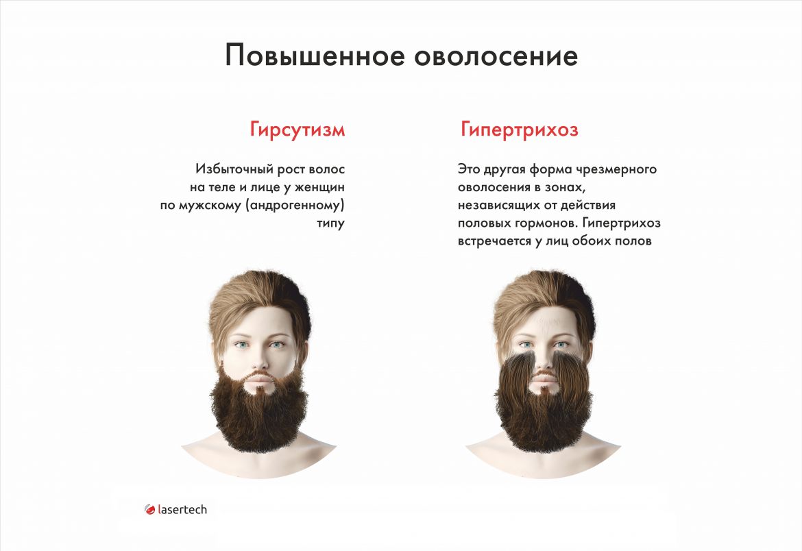 повышенное оволосение.jpg повышенное оволосение.jpg